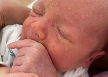 Milije – beličaste promene