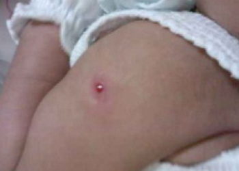 Bcg vakcina – protiv tuberkuloze