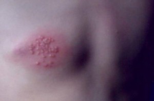 herpes-zoster-534.jpg