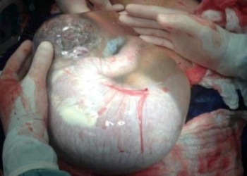 Kako izgleda beba rođena „pod velom“