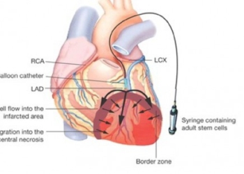 Pacijentove matične ćelije leče oštećenja nastala srčanim udarom