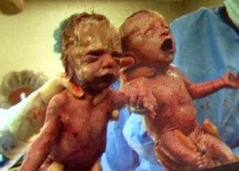 Bliznakinje se rodile držeći se za ruke