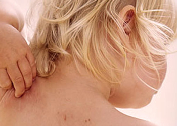 atopijski dermatitis