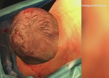 „Nežni carski rez“