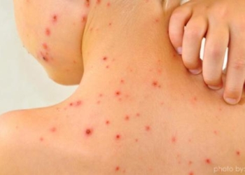 ‘Batut’ upozorava: Srbiji preti opasnost od epidemije malih boginja