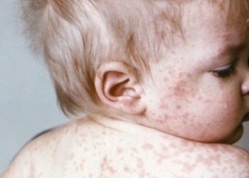 Male boginje: Žalosna istina – raste broj obolelih