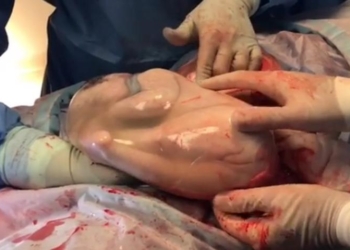 Snimak rođenja koji je obišao svet: Lekari su čekali 7 minuta da se beba probudi