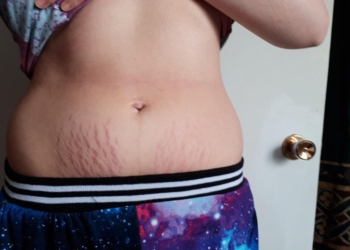 Jedna mama otkrila „lek“ protiv strija