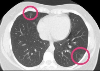 Nije imala nijedan simptom korona virusa,a onda je urađen snimak pluća i hospitalizovana je: Lekari širom sveta bruje o slučaju ove mlade žene