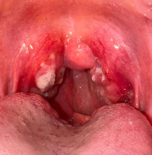 angina