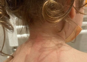 Koprivnjača  kod dece – zablude