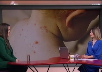 Male boginje mogu biti fatalne po dete – kako prepoznati prve simptome