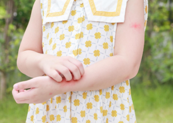 Ujedi insekata – kako prevenirati i šta ako ipak dođe do ujeda