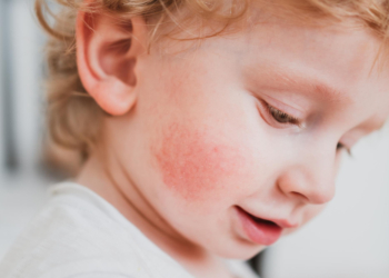 „Peta bolest“ –  blaga virusna infekcija koju izaziva Parvovirus B19