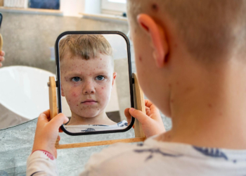 Blizu 5.000 zaraženih od malih boginja, proglašena epidemija u BiH