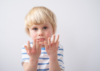 Atopijski dermatitis – drugačiji pristup bolesti